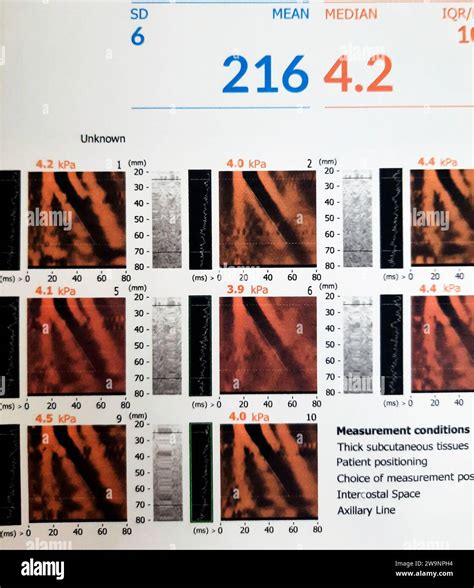 S3264 The Accuracy of Fibroscan: A Real World Study.